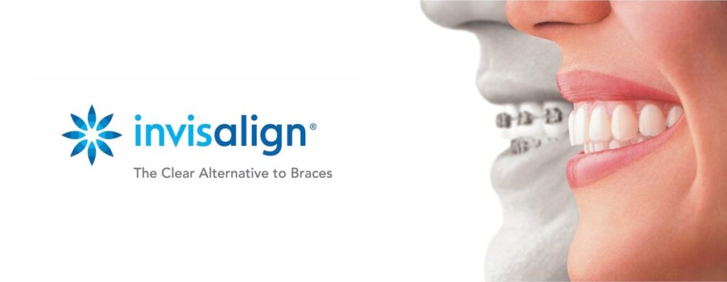 Αξιολόγηση της μεθόδου INVISALIGN μετά από 15 χρόνια προσωπικής εφαρμογής