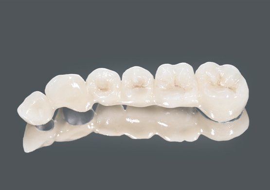 Smile-Designers-olokeramikes_stefanes_2