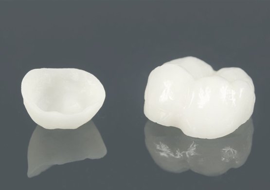 Smile-Designers-olokeramikes_stefanes_4